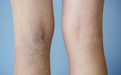 Are Varicose Veins More Than Cosmetic?
