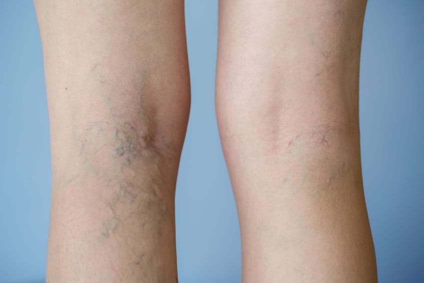 Are Varicose Veins More Than Cosmetic?