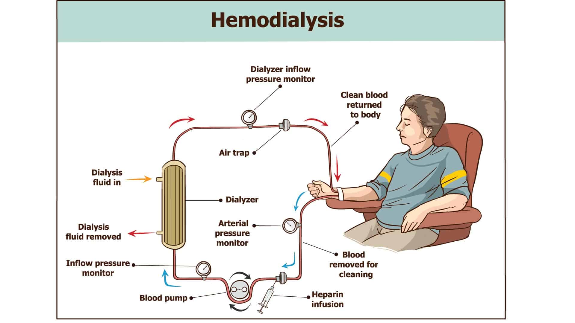 Hemodialysis Diagram