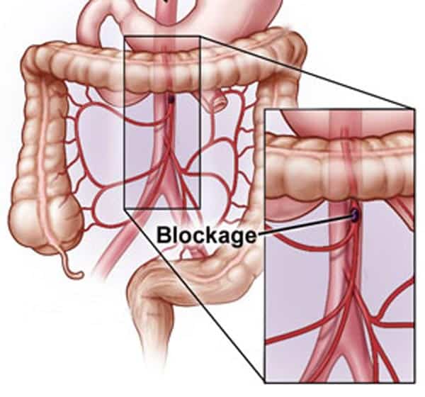 Mesenteric Artery Ischemia