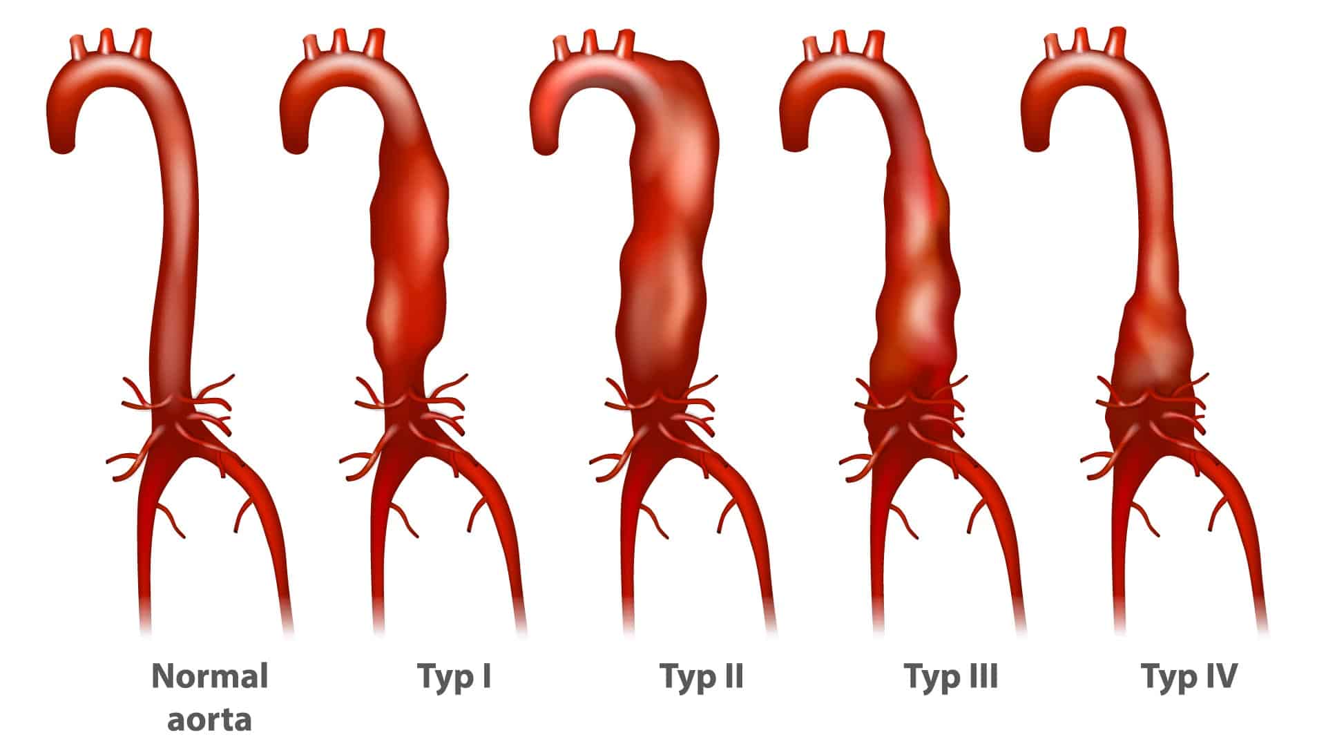 Abdominal Aortic Disease Stages